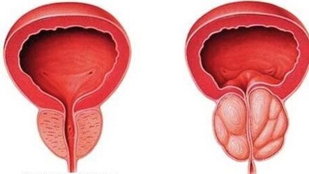 normalna i zapalna prostata